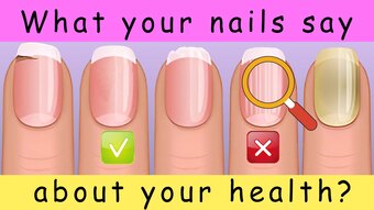 What Do Your Fingernails Reveal About Your Health?